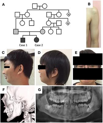 A Novel Pathogenic HSPG2 Mutation in Schwartz–Jampel Syndrome